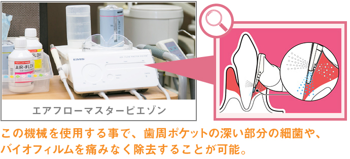 この機械を使用する事で、歯周ポケットの深い部分の細菌や、 バイオフィルムを痛みなく除去することが可能。